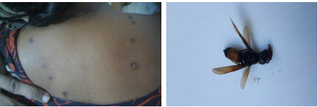 Multiple-sting-marks-with-central-white-necrosis-and-surrounded-erythema-and-the-offender.png